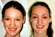 Click to view before & after treatment