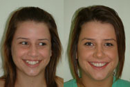 Click to view before & after treatment